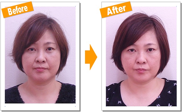 京都で小顔矯正をお探しの方必見!小顔矯正の効果をモニタリング!!Hさん50代 Vol.2
