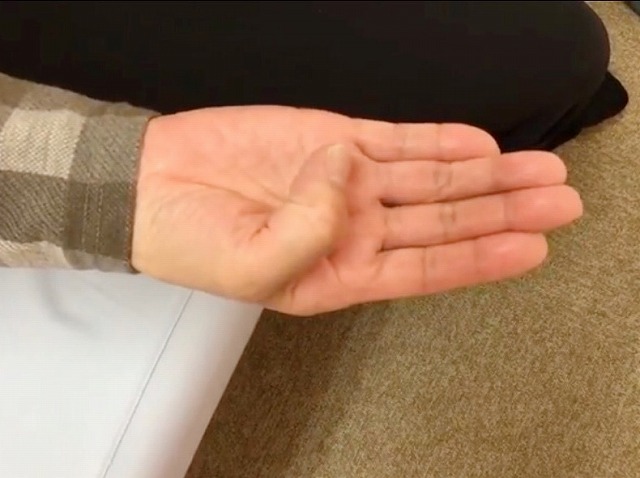 指が動かしにくい!指が動かしにくいバネ指がよくなった患者さんの声!