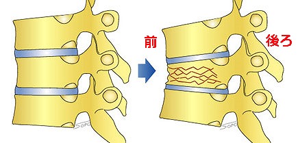 「圧迫骨折」と「ぎっくり腰」|痺れの有無