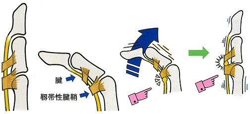 手を握ると指の関節が痛い病名の解説