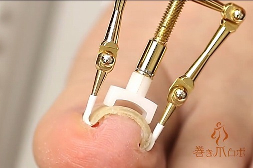 巻き爪が痛い!痛すぎる巻き爪の治し方と原因!すぐに治したいならコレ使いな