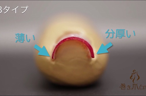 巻き爪が痛い!痛すぎる巻き爪の治し方と原因!すぐに治したいならコレ使いな