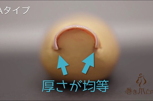 巻き爪が痛い!痛すぎる巻き爪の治し方と原因!すぐに治したいならコレ使いな