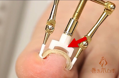 巻き爪が痛い!痛すぎる巻き爪の治し方と原因!すぐに治したいならコレ使いな