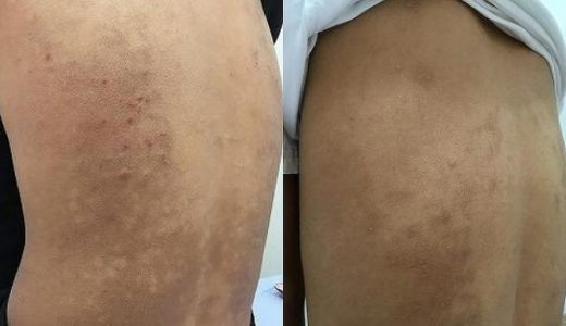 肌荒れとかゆみのアトピー性皮膚炎！合計15回の治療でほぼ完治しました