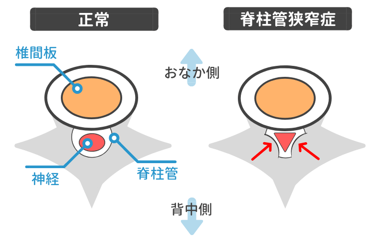 脊柱管狭窄症図解